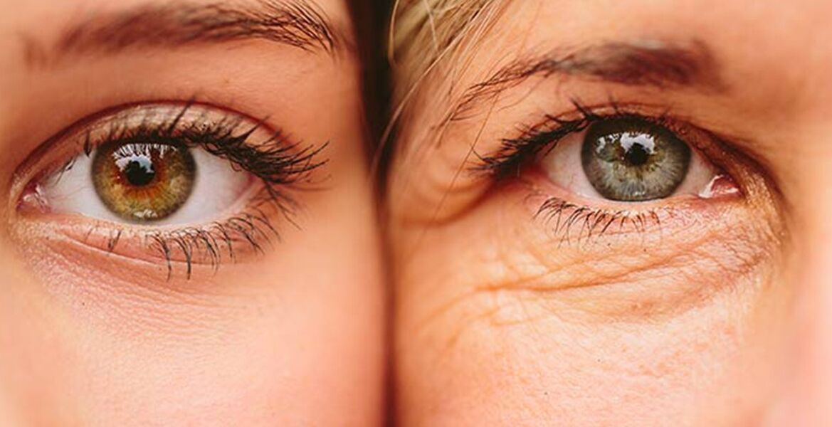 თვალების ირგვლივ კანის დაბერების გარეგანი ნიშნები სხვადასხვა ასაკის ორ ქალში